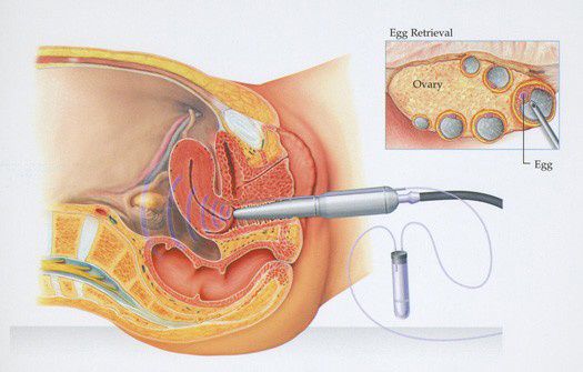 A technician uses an egg retrieval needle guided by ultrasound to extract eggs from the ovaries. A technician uses an egg retrieval needle guided by ultrasound to extract eggs from the ovaries.